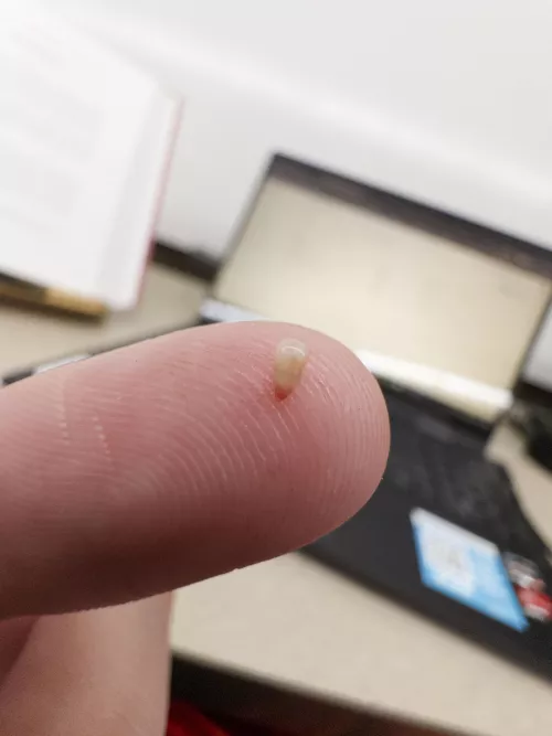 Just yoinked this little guy out of my back