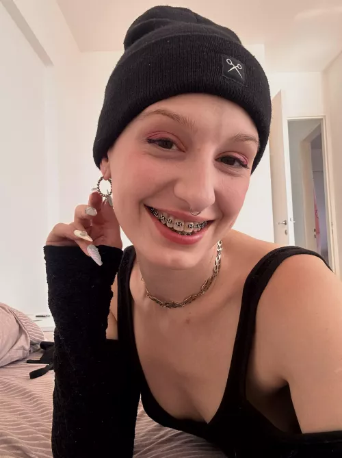 would you say braces suits to my face?