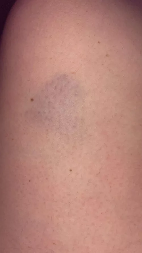 I like when the bruises start to show up 