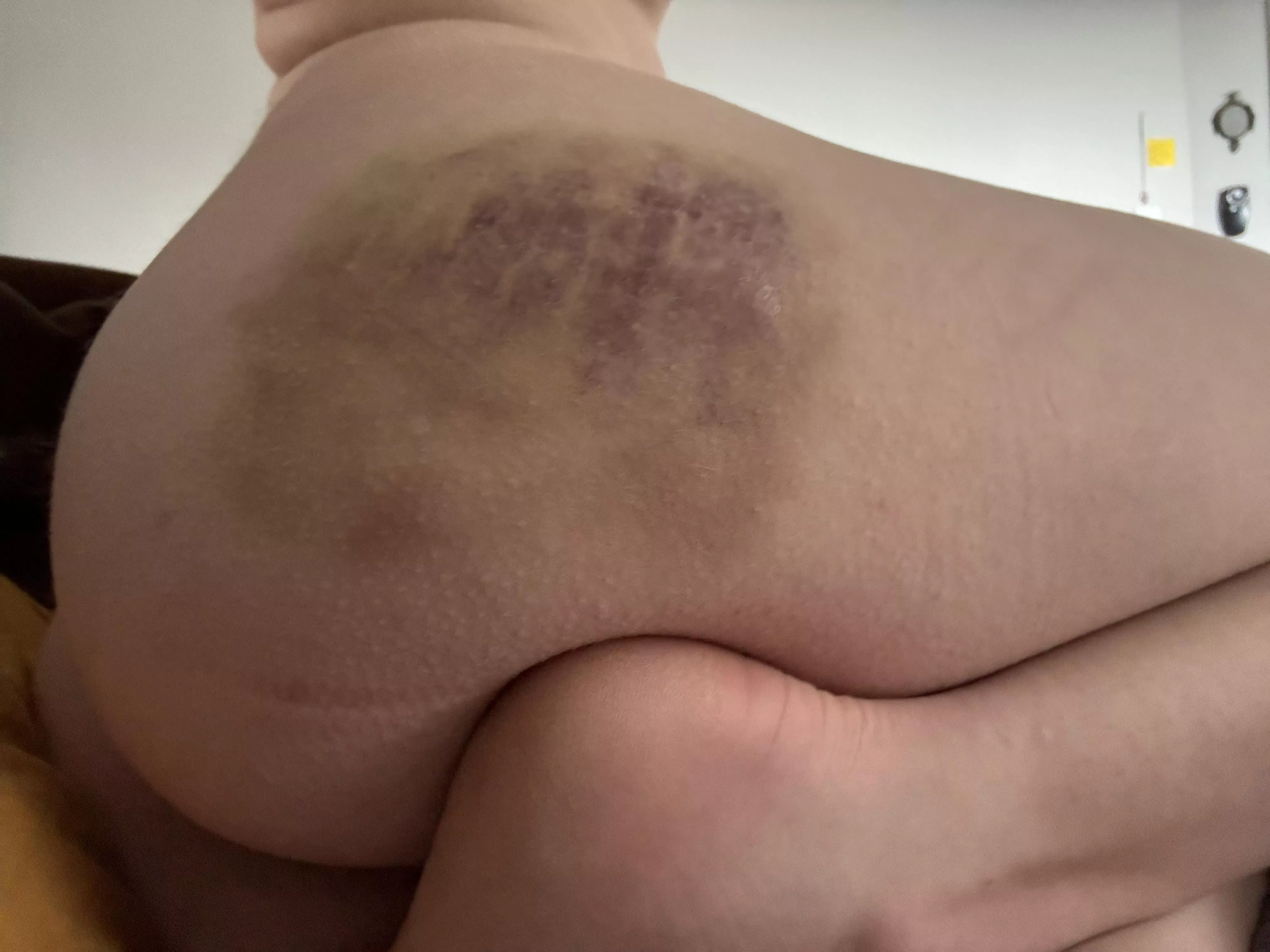 Results of being a bit too bratty :(