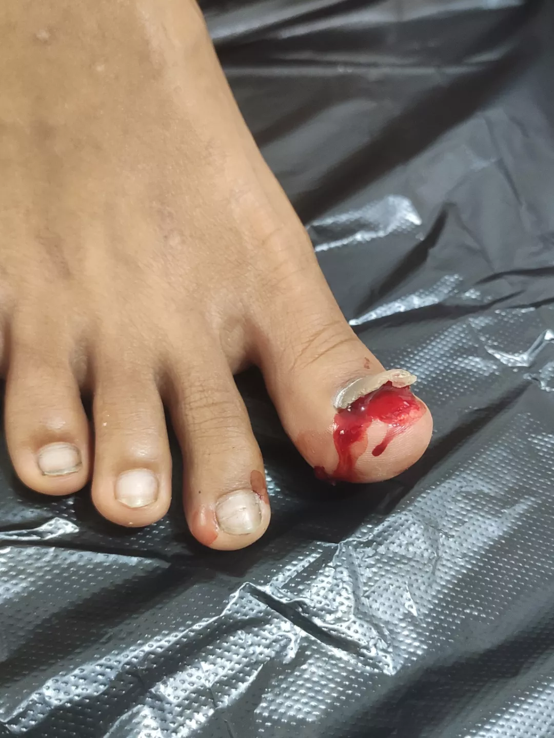 Accidental Nail avulsion 