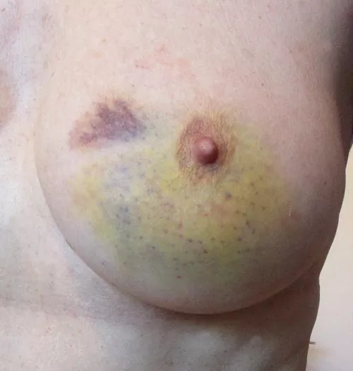 After punching and needling