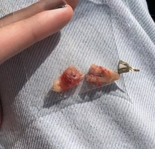 Dentist broke my tooth. 