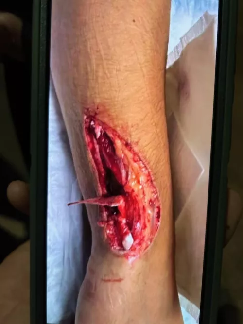 Shattered window pane at work slices apprentice glaziers arm.