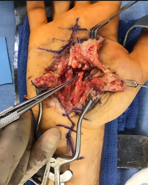 Surgery photos of my sliced hand. 