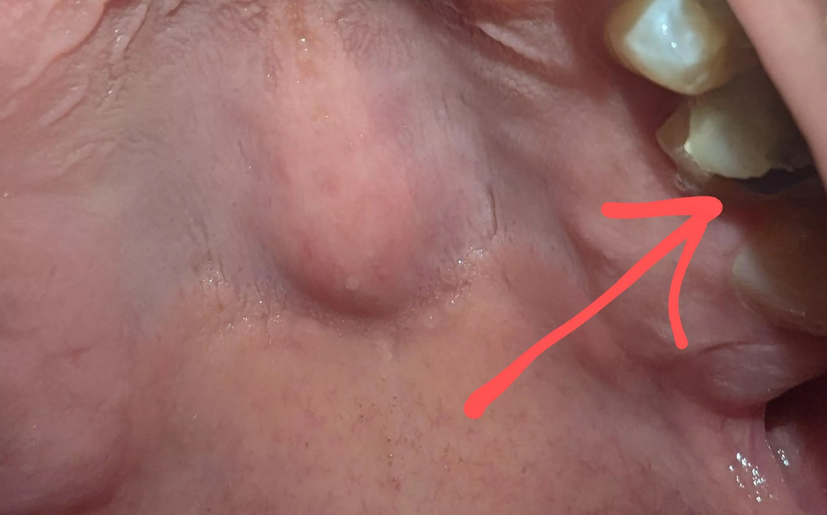 Does my temporary crown supposed to look like this? Severe pain. 