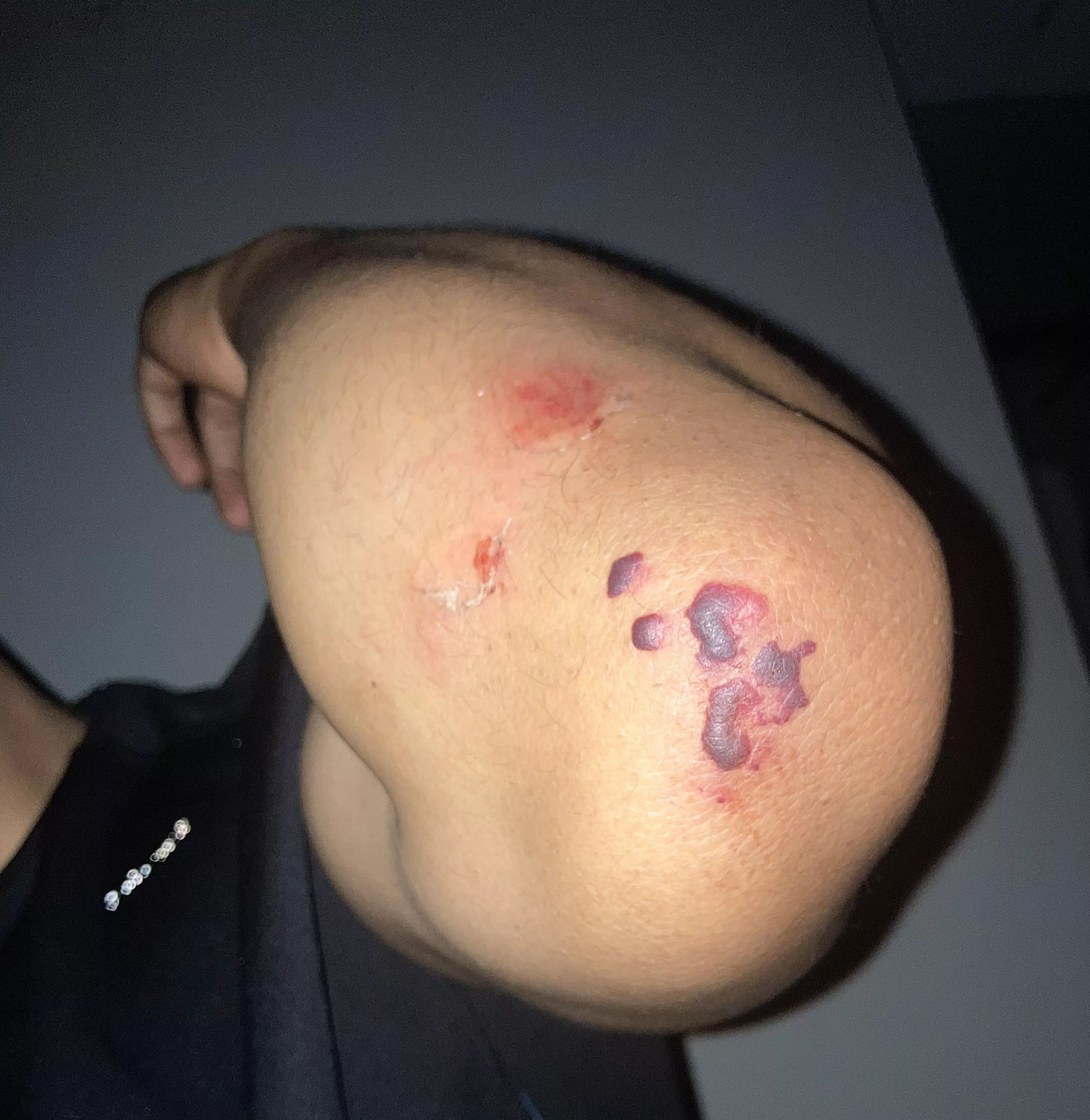 Fell off my bike today 