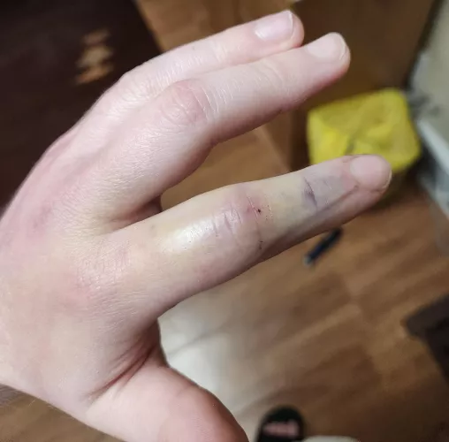 Had a laceration from my finger being smashed. The entire back of my finger has turned yellow after 4 days? Should I be concerned?