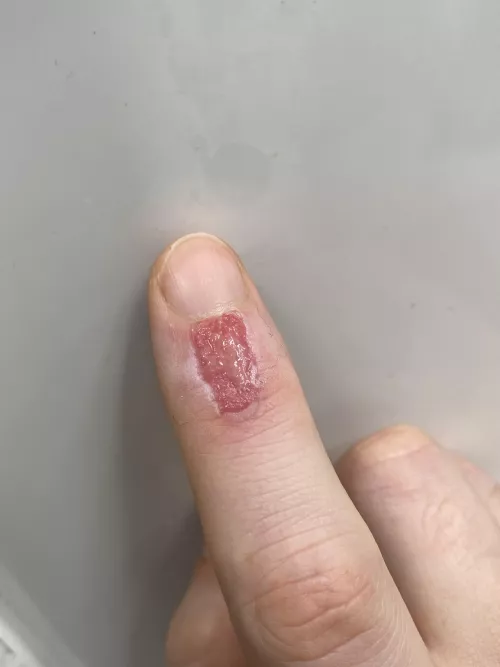 Hot Glue Burn
