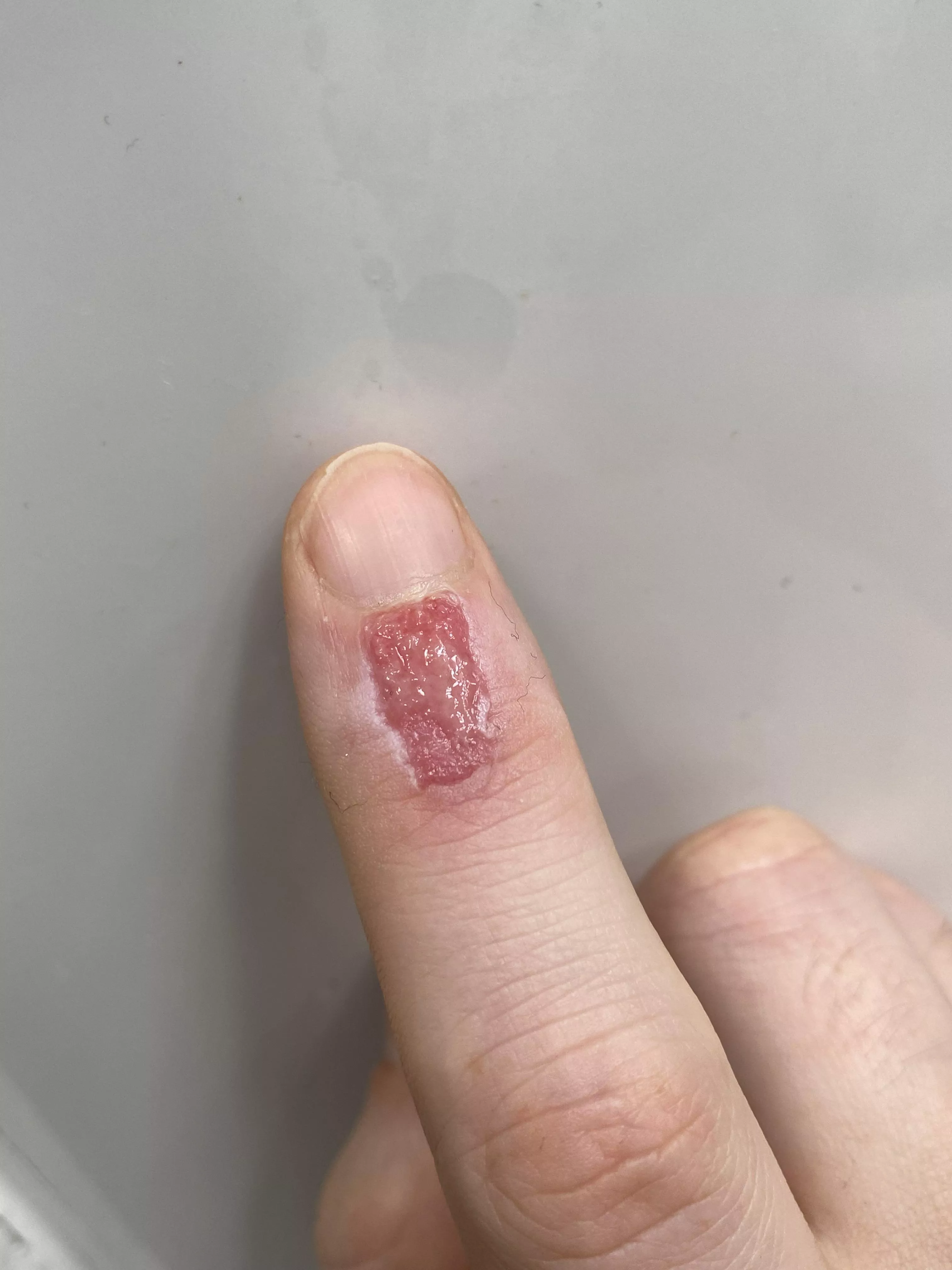 Hot Glue Burn