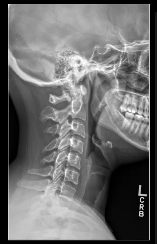 How long did your neck sprain or strain take to heal? 