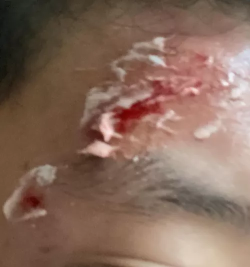 Just hit head very hard is this gonna leave a scar