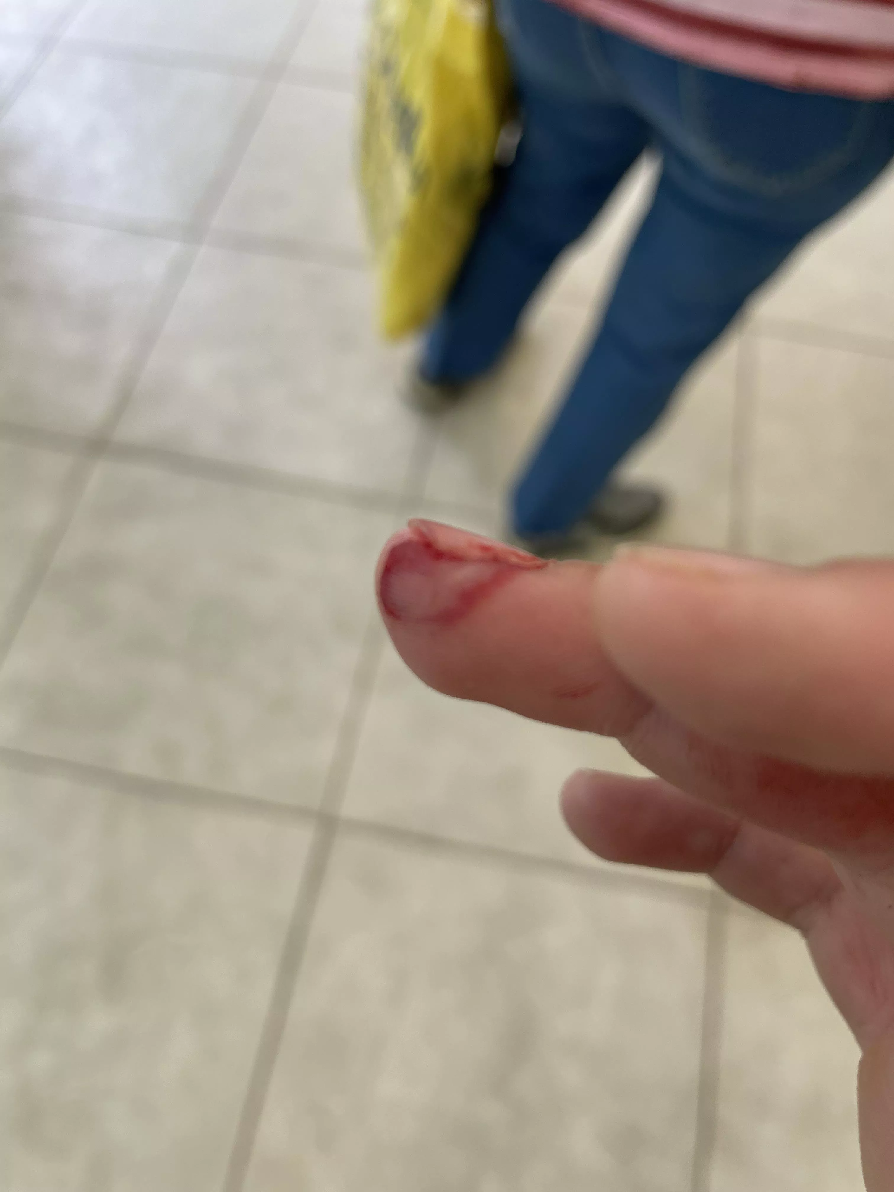 Lacerated finger from Shimano Deore 