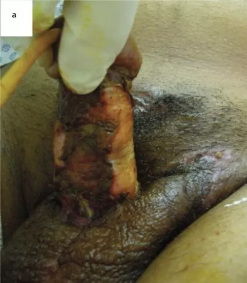 Penile skin necrosis after silicone oil injection. The patient needed surgery and skin grafts. 