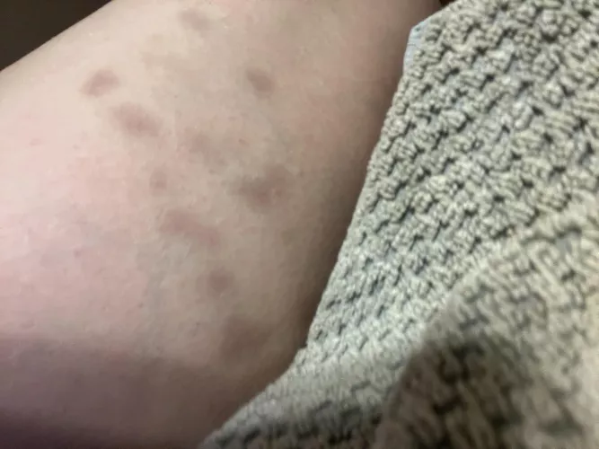 Unexplained Bruising?