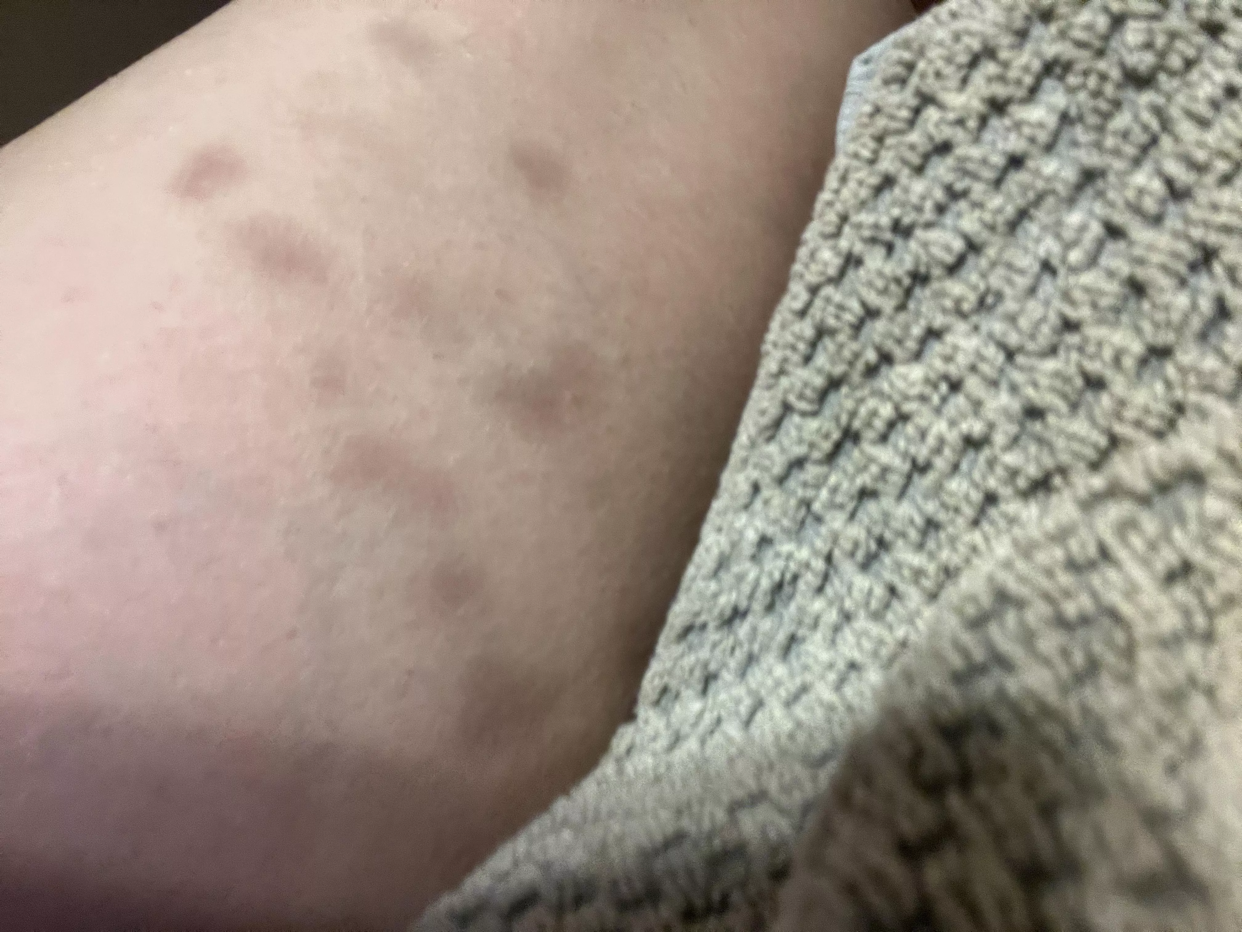 Unexplained Bruising?
