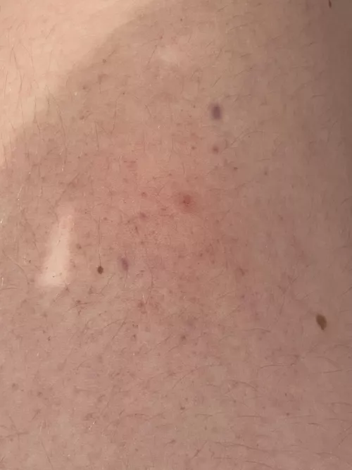 Weird spots appearing on me 