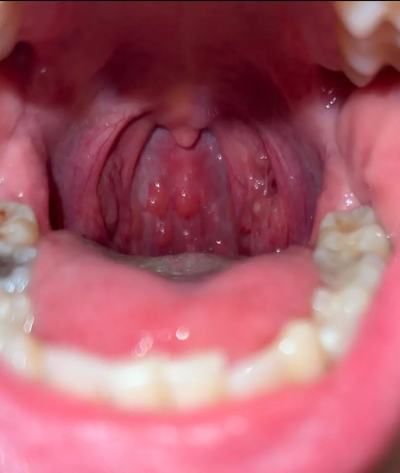 What are these red bumps at the back of my throat?