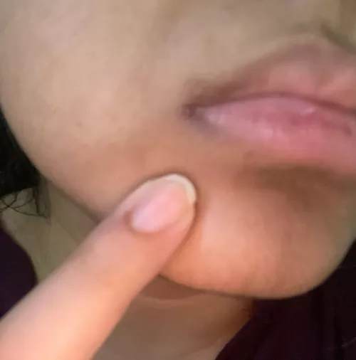 What’s is wrong at the angle of my mouth 