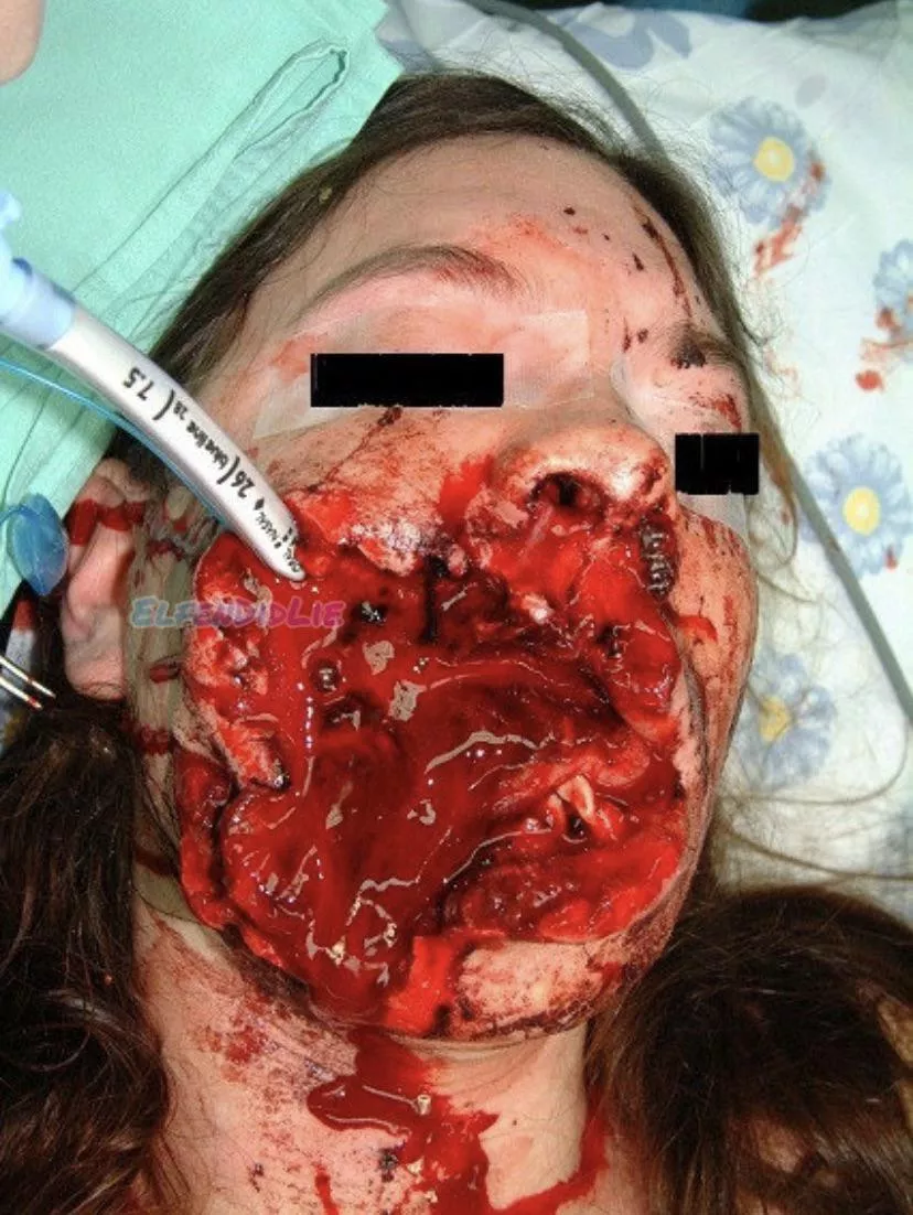 A woman who sustained a single gunshot injury