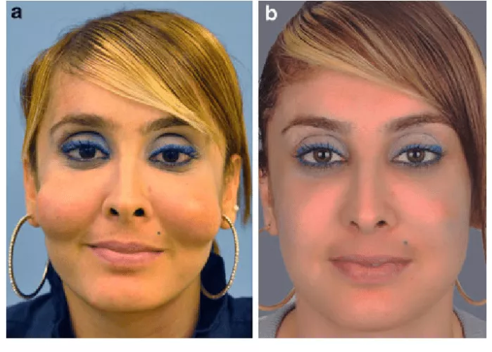 Long-term complications of polyethylene glycol fillers to the cheeks. The case report describes the lumps as 