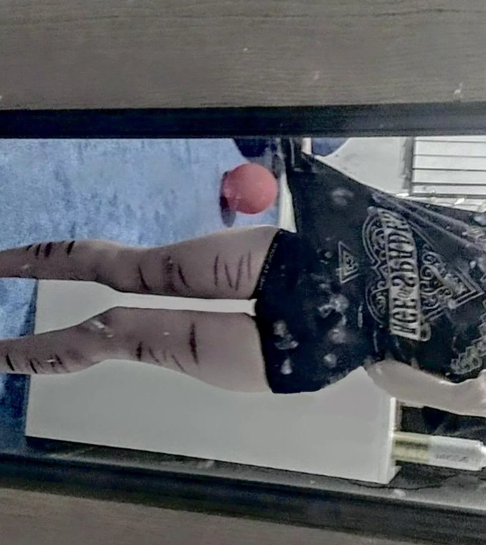 Old pic when my scars were more obvious(fully healed btw, just dark scar tissue )