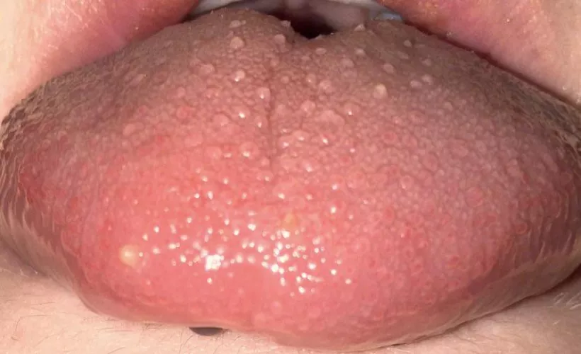 Tongue looks weird?