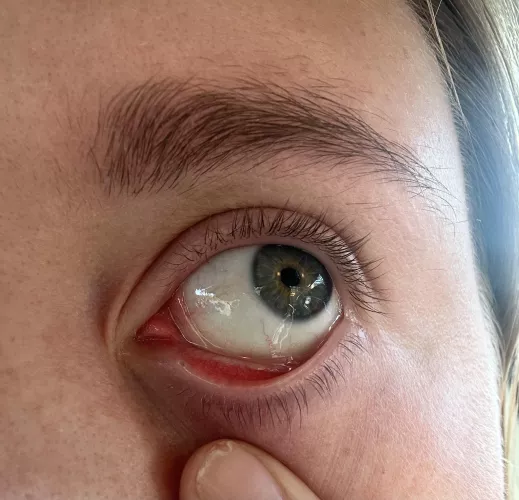 What is this inside the corner of my eyelid? 