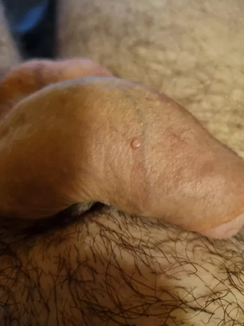 32m What is this lump on my penis