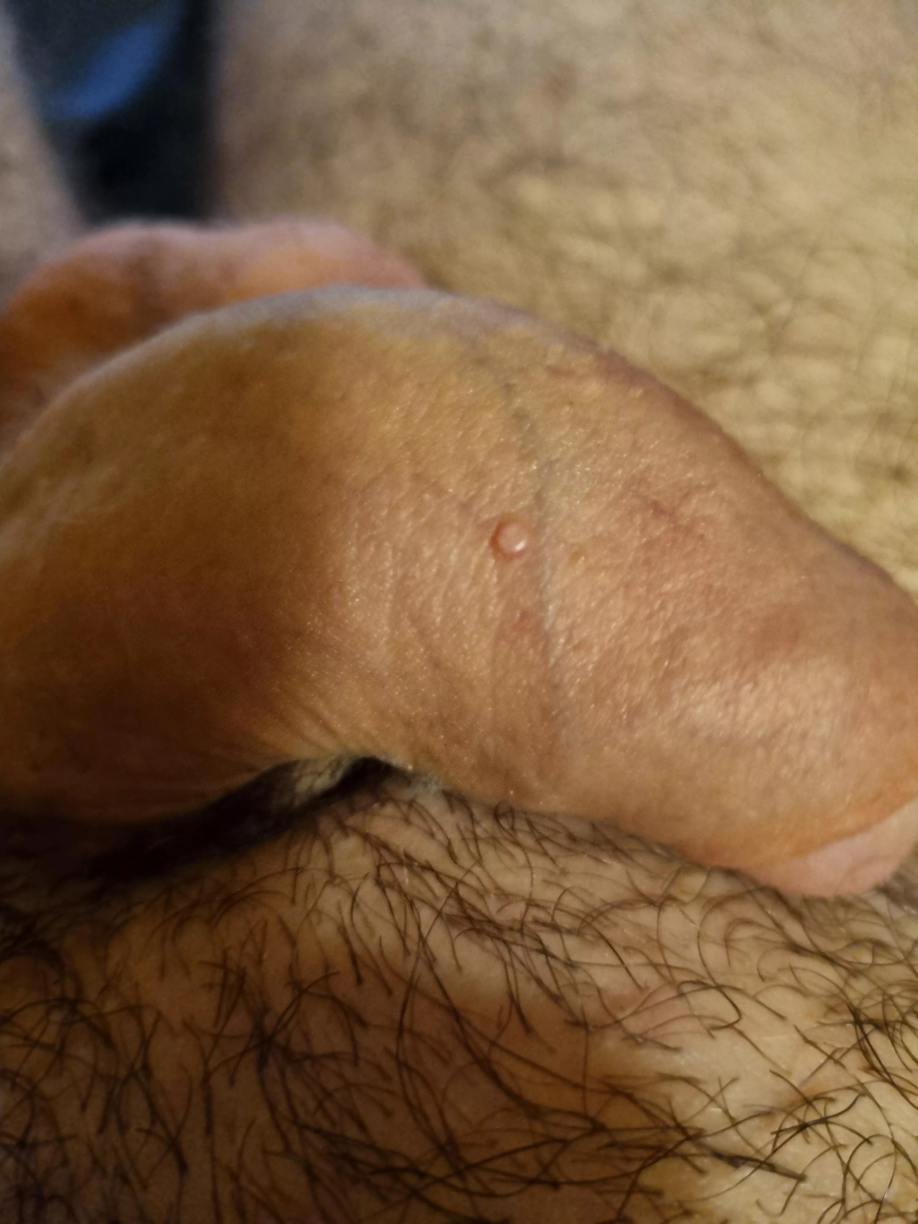 32m What is this lump on my penis