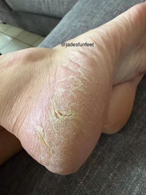 Dry Feet need love too