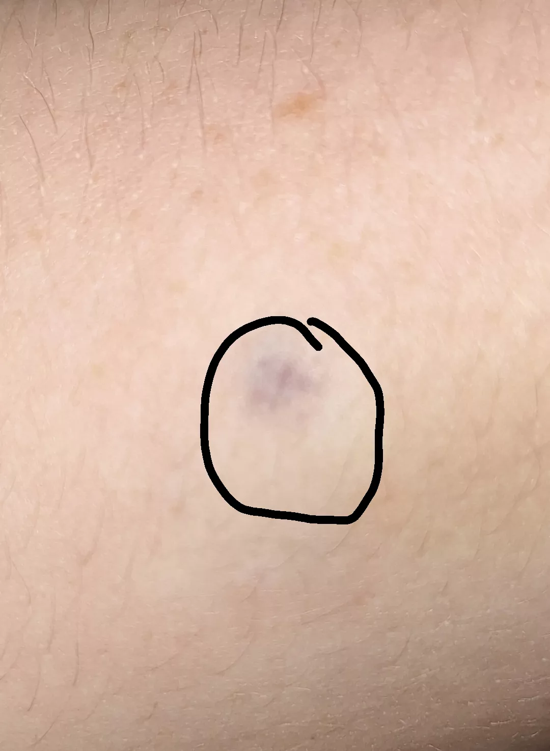 Have had this weird purplish bruise on my arm for over 3 years