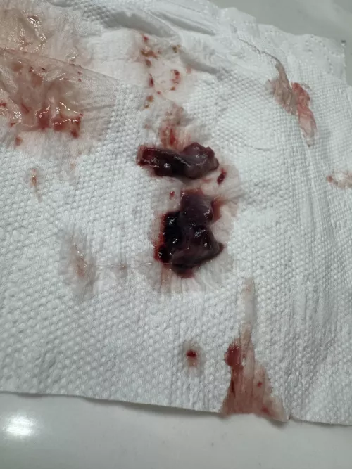 I had nose/ sinuse surgery, this came out of my nose today