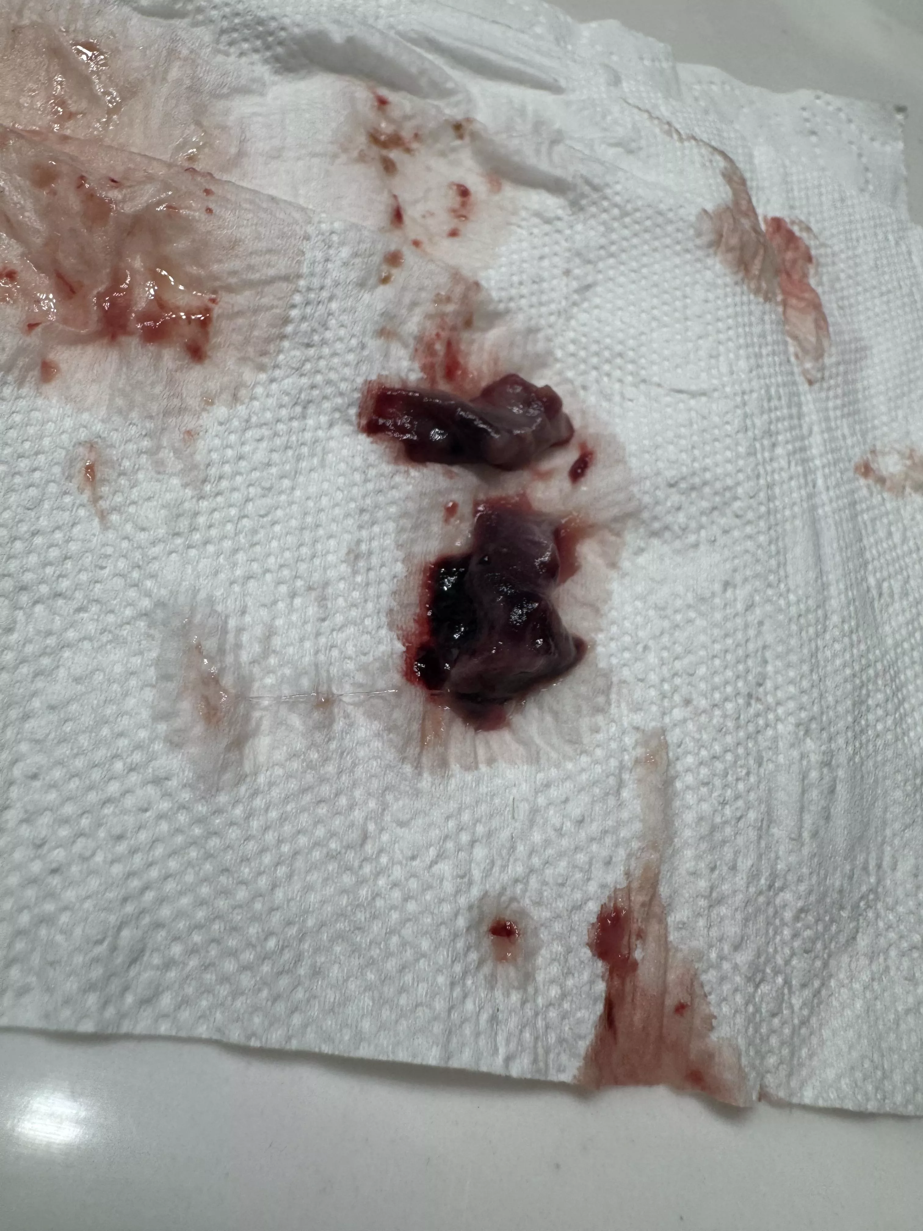 I had nose/ sinuse surgery, this came out of my nose today