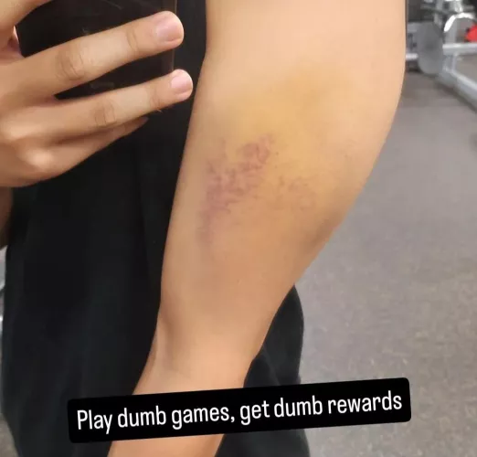 Internal bleeding or nah?