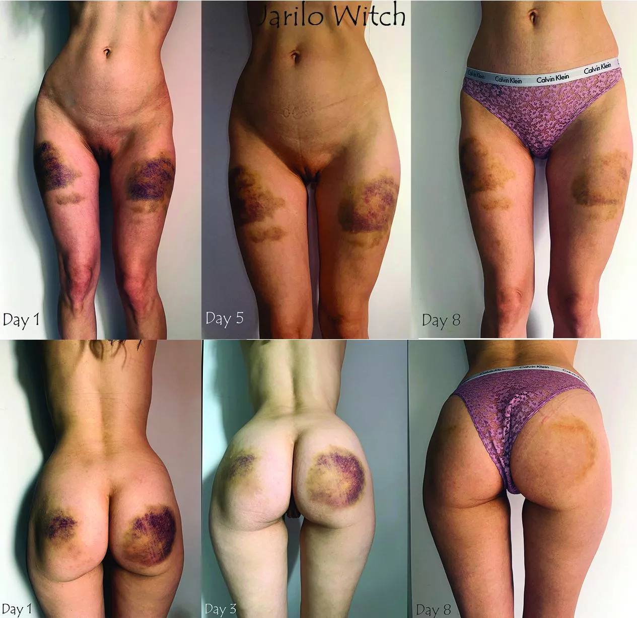 My healing process after a solid whipping on both front and back