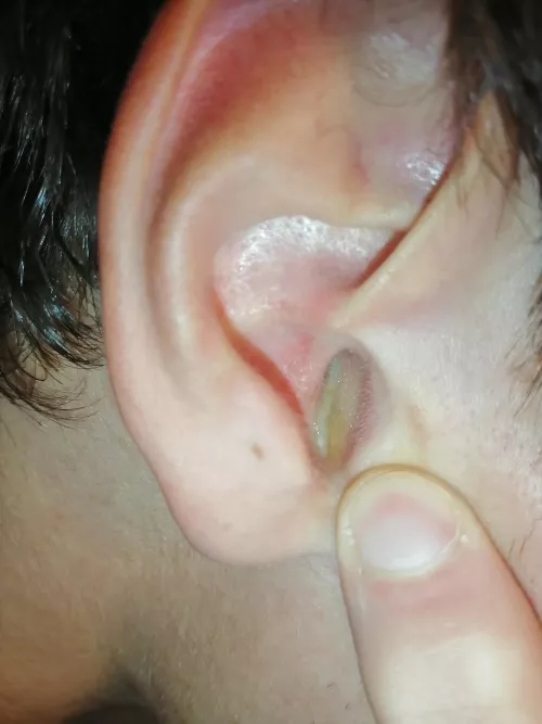 Otitis infection