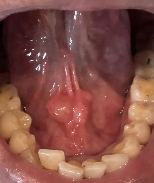 Please help!!  Cyst since 2 month