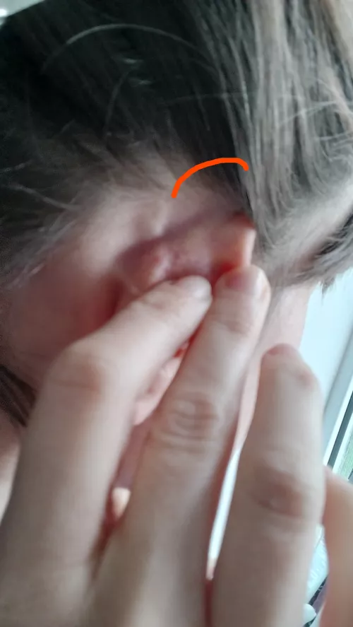 Raised painful lump/vein starting in ear lobe then curling up to scalp