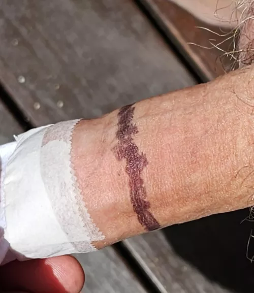 I did an experiment to see how much more skin I needed to reach past the tip of my glans. I was flabbergasted to say the least. Oh well, I guess I'm not the fastest restoration ever. 