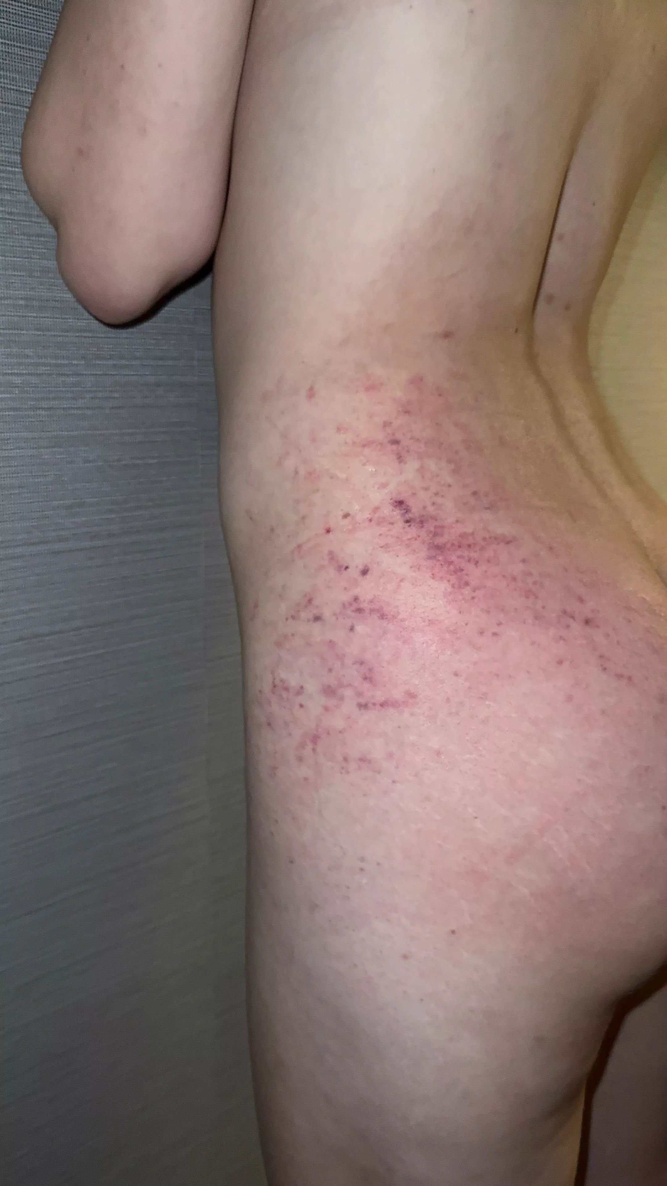 Preview of the marks that were left on my body after I was restraint to the cross 💥