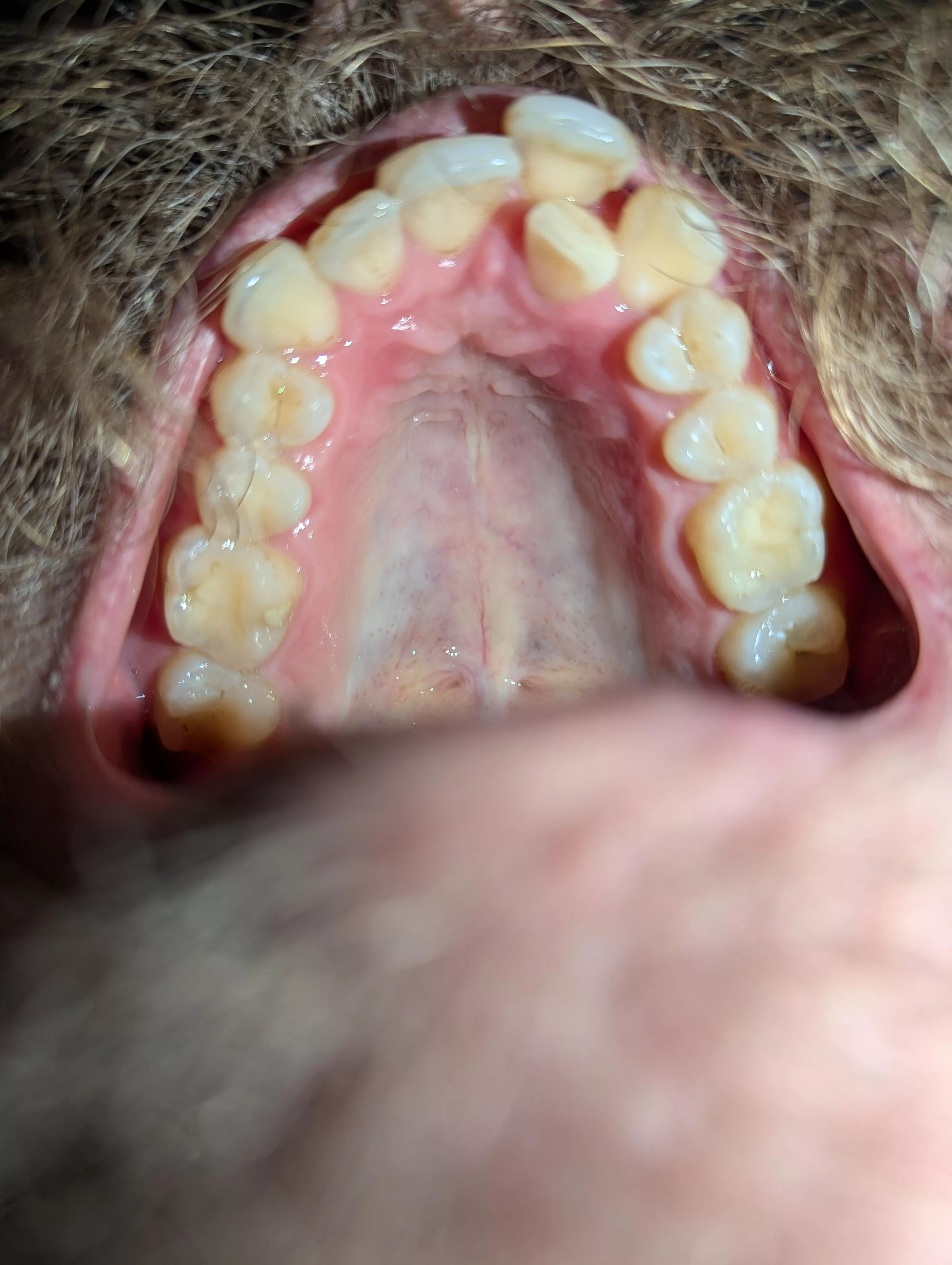 Does my roof of the mouth look normal