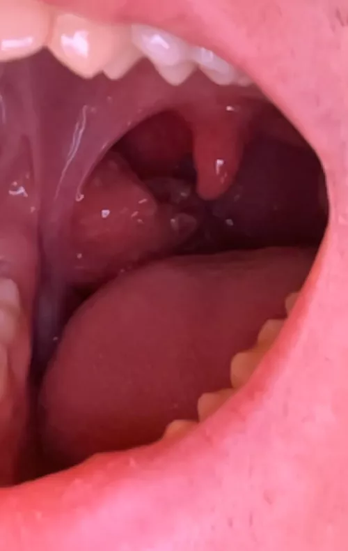 Funny looking tonsil