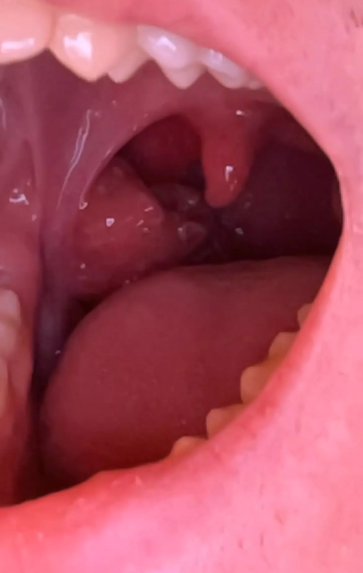 Funny looking tonsil