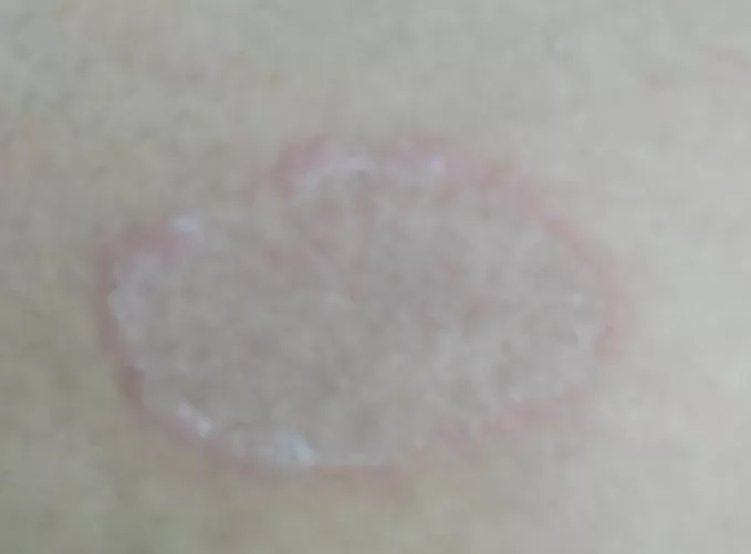 Got this after I shaved my chest hair,doesn't hurt but what is this?