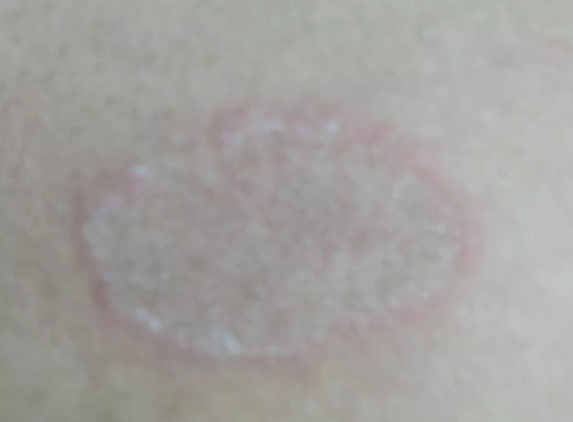 Got this after I shaved my chest hair,doesn't hurt but what is this?