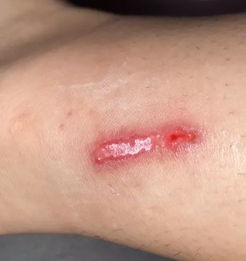 got this cut, pretty sure the white part is from a powder ive been putting on it called sulfatiazol. i do swimming and obviously it burns so ive been trying to heal it fast with the powder but it hasnt helped? any suggestions and like is it serious?? 