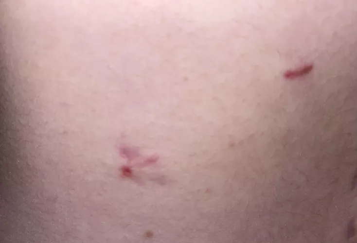 Internal stitch popping out on lower incision (little red dot). Will it make its way out on its own? It’s keeps getting irritated.