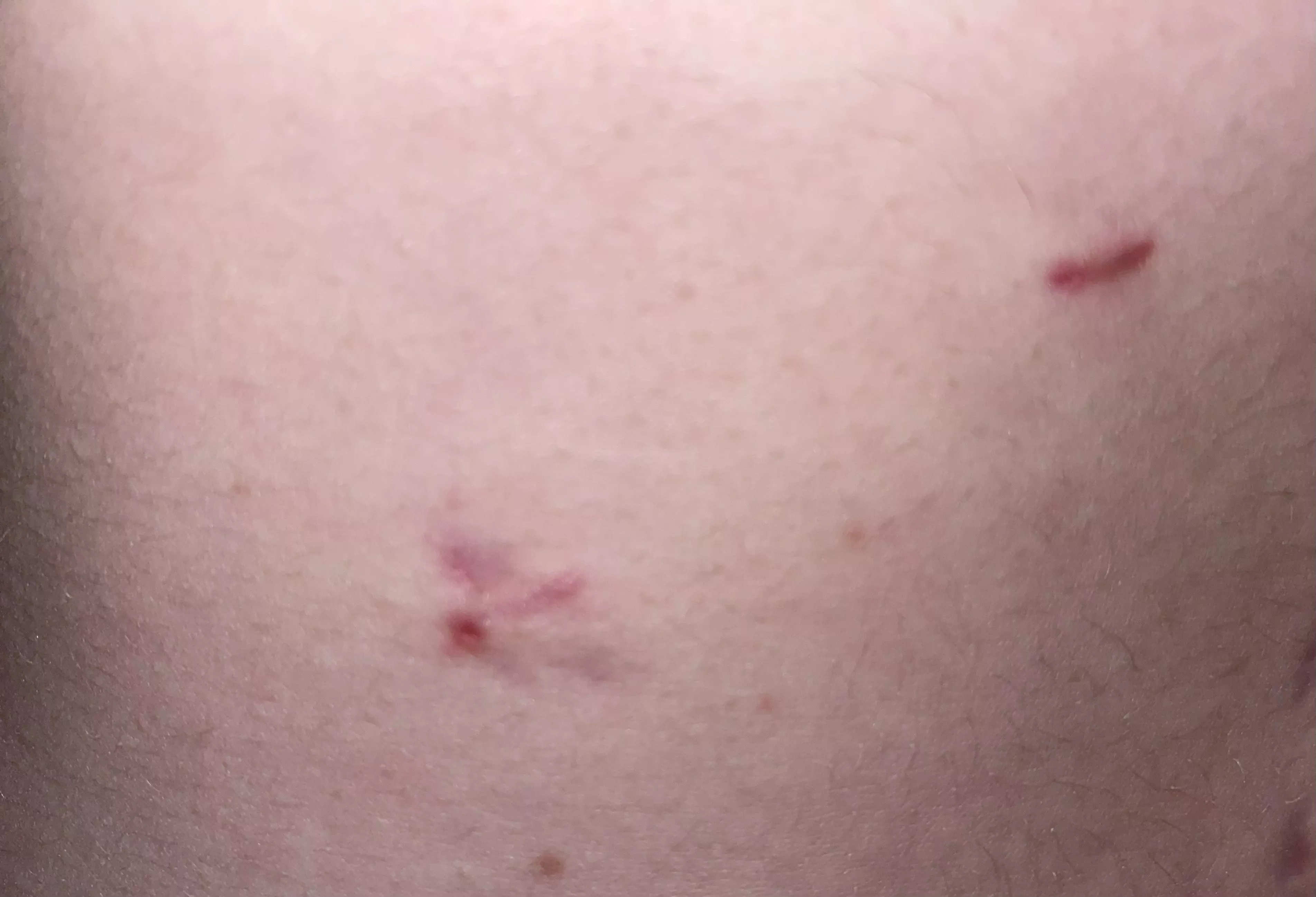 Internal stitch popping out on lower incision (little red dot). Will it make its way out on its own? It’s keeps getting irritated.