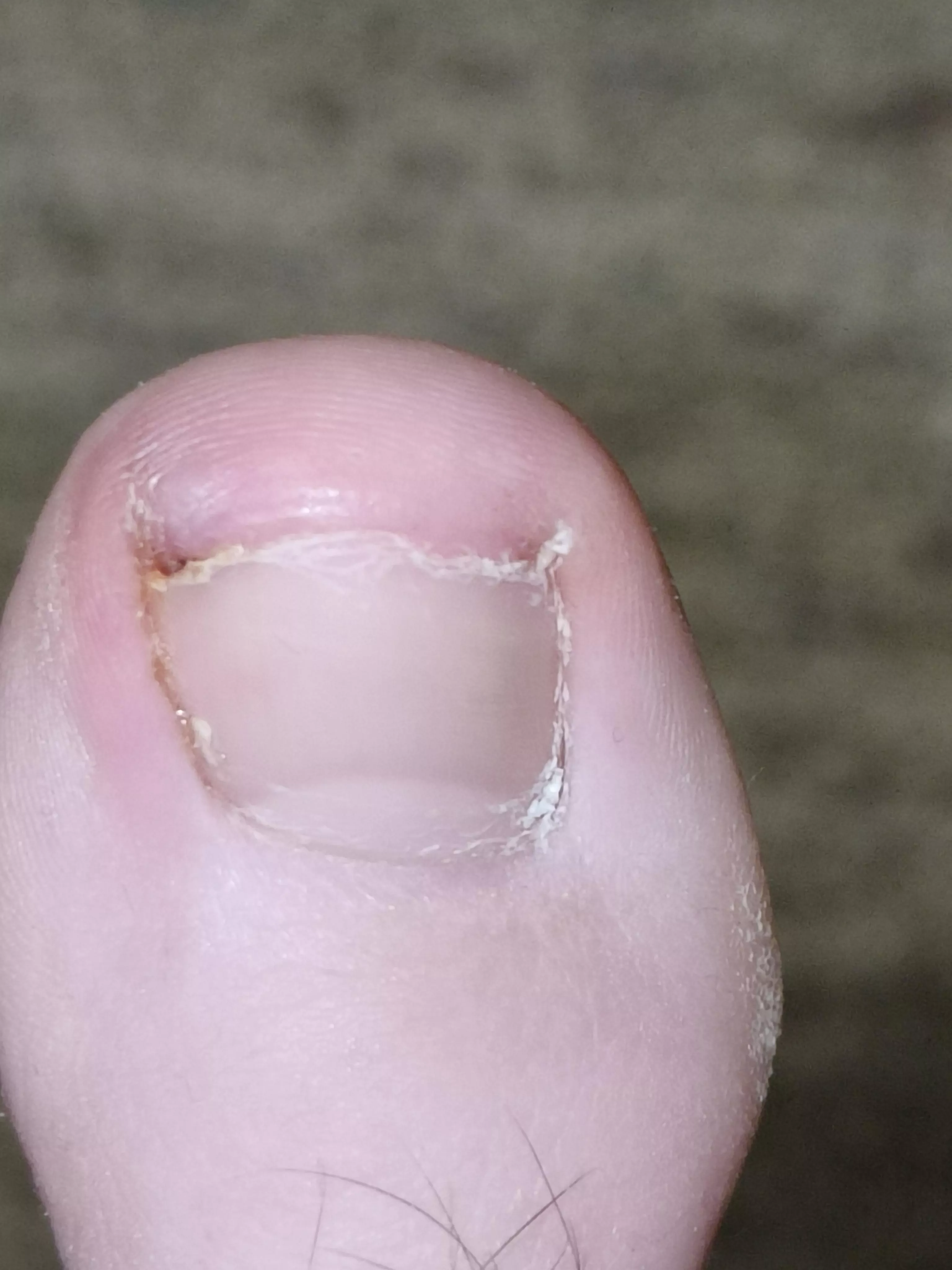 Is my toe possibly inflamed?